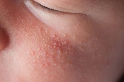If You Have These Tiny, White Bumps on Your Face, Don’t Try to Remove Them!